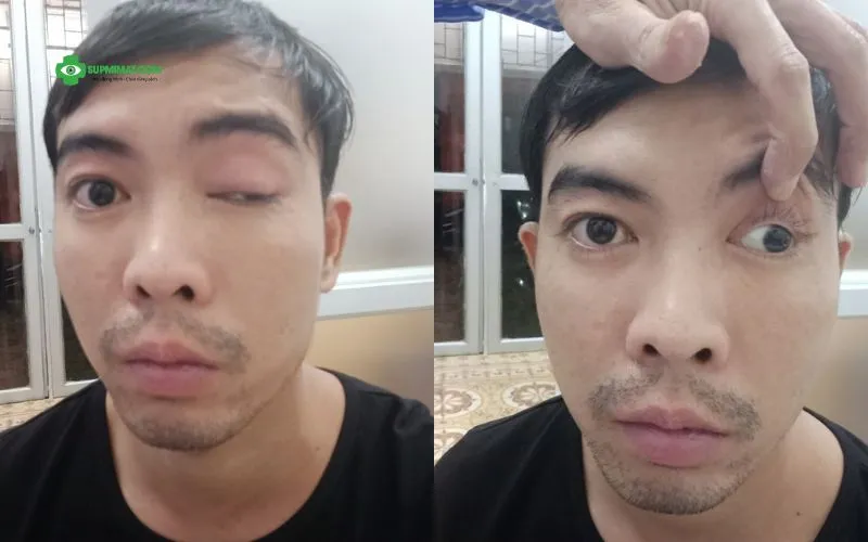 Hình ảnh trước và sau điều trị Liệt dây thần kinh số 3 tại Đông y Sơn Hà