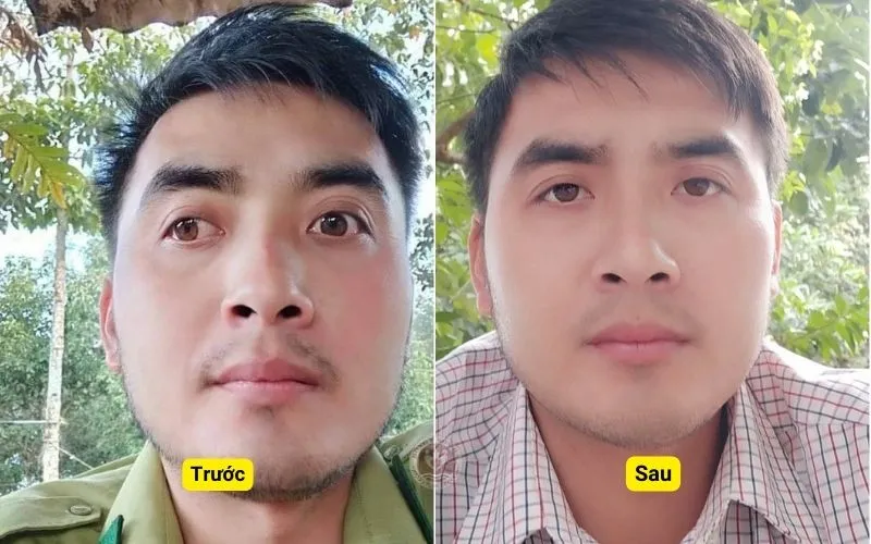 Hình ảnh trước và sau điều trị mắt lác tại Đông y Sơn Hà
